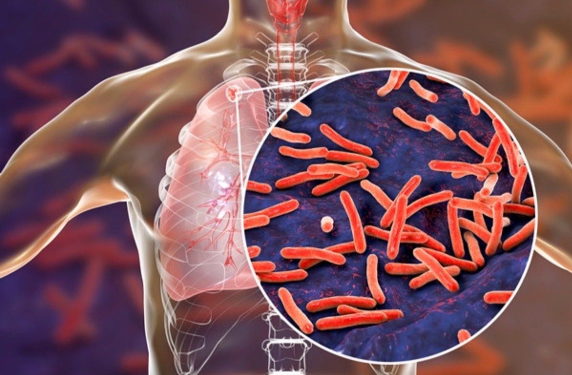 Tacoma, WA Woman with Tuberculosis Who Refuses Treatment Will Be Arrested for Treatment on Friday