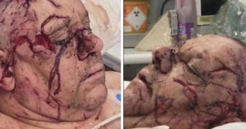 Northern Ireland: Belfast Victim Remains in Serious Condition with Horrific Facial Wounds as Details Emerge About Deranged Sudanese Attacker