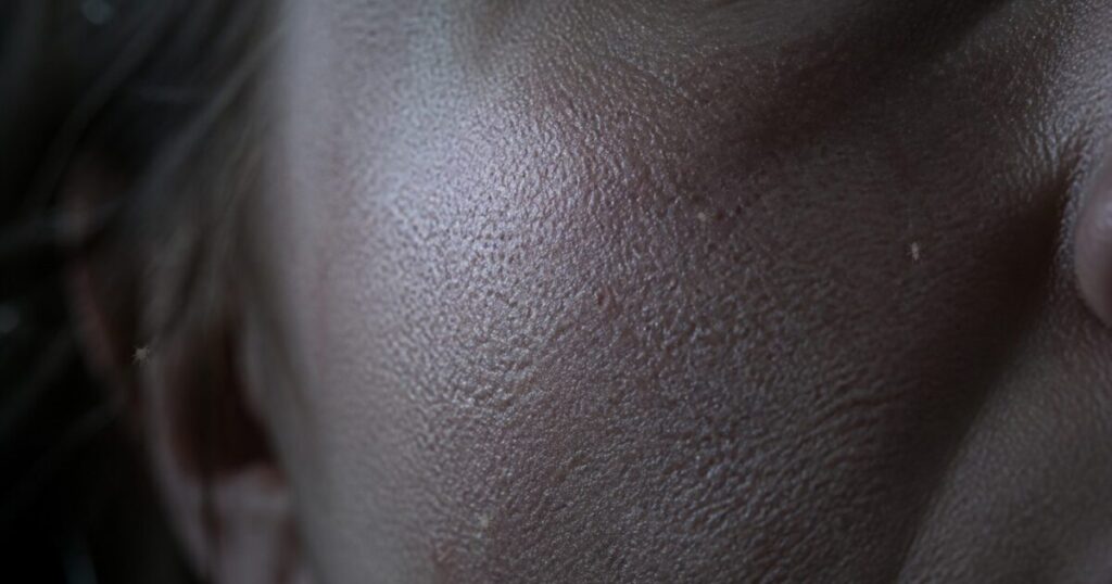 Crazy As It Sounds, There Are Probably Microscopic Mites In Your Face Pores That Come Out At Night